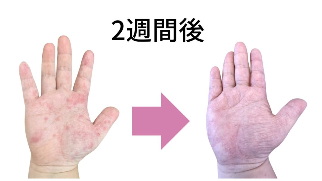 手荒れ改善