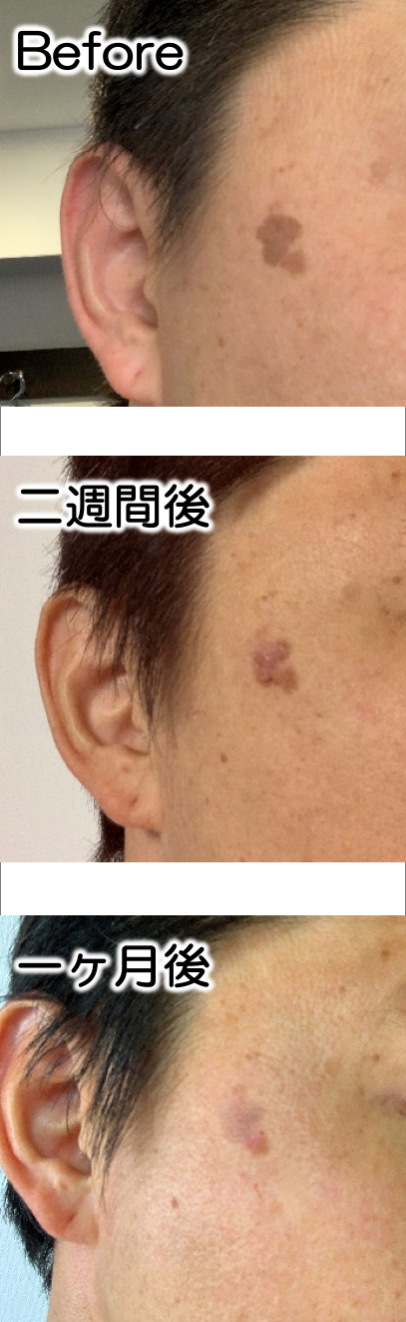 シミが消える工程